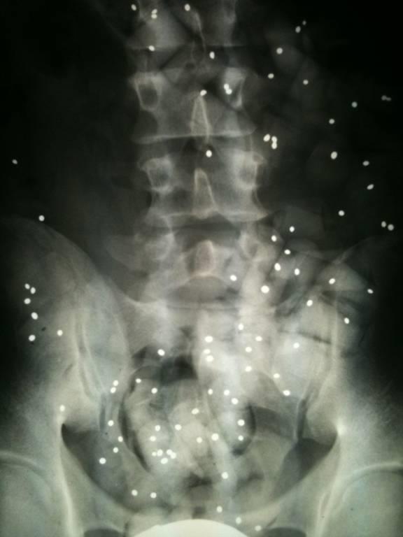 spezifische Ursache für Rückenschmerzen