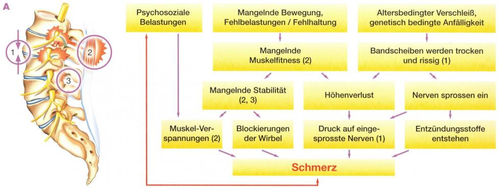 Warum schmerzt der Rücken?